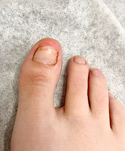 Fungal Nails Treatment in the New York County, NY: Manhattan, Lenox Hill, Yorkville, Upper West Side, Upper East Side, Hell's Kitchen, Midtown East, Garment District, Diamond District, Carnegie Hill, Lincoln Square, Murray Hill areas
