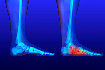 Flat feet and Fallen Arches treatment, Flatfoot Deformity Treatment in the New York County, NY: Manhattan, Lenox Hill, Yorkville, Upper West Side, Upper East Side, Hell's Kitchen, Midtown East, Garment District, Diamond District, Carnegie Hill, Lincoln  Square, Murray Hill areas
