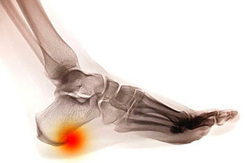 Heel spurs treatment in the New York County, NY: Manhattan, Lenox Hill, Yorkville, Upper West Side, Upper East Side, Hell's Kitchen, Midtown East, Garment District, Diamond District, Carnegie Hill, Lincoln  Square, Murray Hill areas