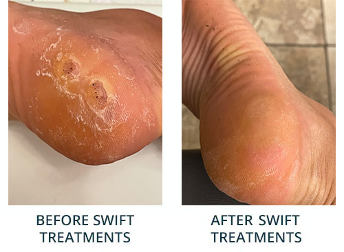 Warts Before & After SWIFT Treatment SWIFT Treatment for Plantar Warts in the New York County, NY: Manhattan, Lenox Hill, Yorkville, Upper West Side, Upper East Side, Hell's Kitchen, Midtown East, Garment District, Diamond District, Carnegie Hill, Lincoln Square, Murray Hill areas