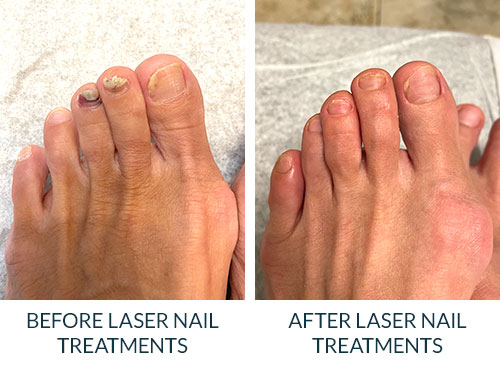 Toe Fungus Removal Pensacola FL | East Hill Medical Group