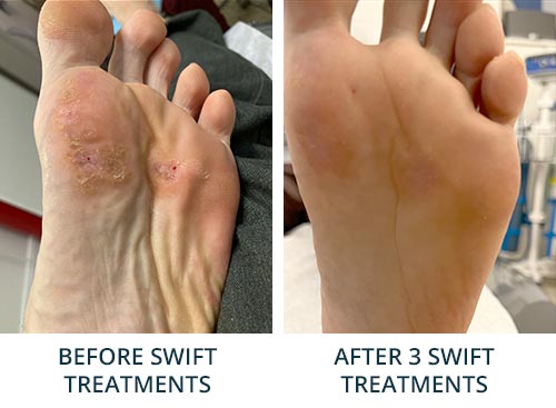Before and After SWIFT treatment