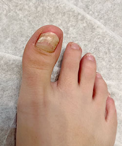 Fungal Nails Treatment Fungal Nails Treatment in the New York County, NY: Manhattan, Lenox Hill, Yorkville, Upper West Side, Upper East Side, Hell's Kitchen, Midtown East, Garment District, Diamond District, Carnegie Hill, Lincoln Square, Murray Hill areas