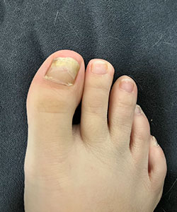 Fungal Nails Treatment in the New York County, NY: Manhattan, Lenox Hill, Yorkville, Upper West Side, Upper East Side, Hell's Kitchen, Midtown East, Garment District, Diamond District, Carnegie Hill, Lincoln Square, Murray Hill areas