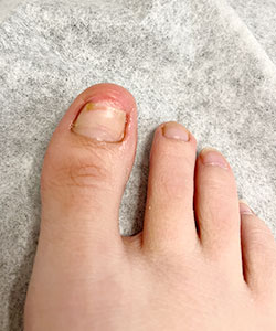 Fungal Nails Treatment Fungal Nails Treatment in the New York County, NY: Manhattan, Lenox Hill, Yorkville, Upper West Side, Upper East Side, Hell's Kitchen, Midtown East, Garment District, Diamond District, Carnegie Hill, Lincoln Square, Murray Hill areas