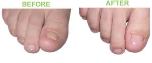  Keryflex™ Nail Restoration System Technique in the New York County, NY: Manhattan, Lenox Hill, Yorkville, Upper West Side, Upper East Side, Hell's Kitchen, Midtown East, Garment District, Diamond District, Carnegie Hill, Lincoln  Square, Murray Hill areas
