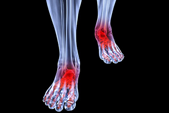 Arthritic foot and ankle care treatment, foot arthritis treatment in the New York County, NY: Manhattan, Lenox Hill, Yorkville, Upper West Side, Upper East Side, Hell's Kitchen, Midtown East, Garment District, Diamond District, Carnegie Hill, Lincoln  Square, Murray Hill areas