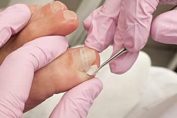 Ingrown toenails treatment in the New York County, NY: Manhattan, Lenox Hill, Yorkville, Upper West Side, Upper East Side, Hell's Kitchen, Midtown East, Garment District, Diamond District, Carnegie Hill, Lincoln  Square, Murray Hill areas
