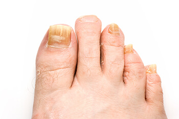 Fungal toenails, toenail fungus diagnosis and treatment in the New York County, NY: Manhattan, Lenox Hill, Yorkville, Upper West Side, Upper East Side, Hell's Kitchen, Midtown East, Garment District, Diamond District, Carnegie Hill, Lincoln  Square, Murray Hill areas