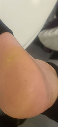 Before & After SWIFT Treatment Swift Treatment in the New York County, NY: Manhattan, Lenox Hill, Yorkville, Upper West Side, Upper East Side, Hell's Kitchen, Midtown East, Garment District, Diamond District, Carnegie Hill, Lincoln Square, Murray Hill areas