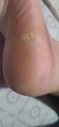 Before & After SWIFT Treatment Swift Treatment in the New York County, NY: Manhattan, Lenox Hill, Yorkville, Upper West Side, Upper East Side, Hell's Kitchen, Midtown East, Garment District, Diamond District, Carnegie Hill, Lincoln Square, Murray Hill areas