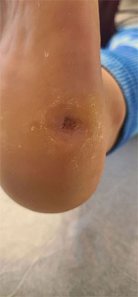 Before & After SWIFT Treatment Swift Treatment in the New York County, NY: Manhattan, Lenox Hill, Yorkville, Upper West Side, Upper East Side, Hell's Kitchen, Midtown East, Garment District, Diamond District, Carnegie Hill, Lincoln Square, Murray Hill areas