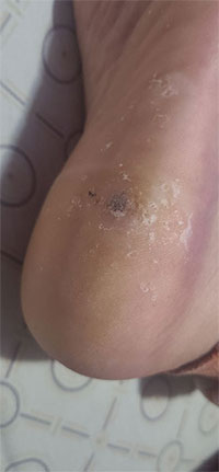 Before & After SWIFT Treatment Swift Treatment in the New York County, NY: Manhattan, Lenox Hill, Yorkville, Upper West Side, Upper East Side, Hell's Kitchen, Midtown East, Garment District, Diamond District, Carnegie Hill, Lincoln Square, Murray Hill areas