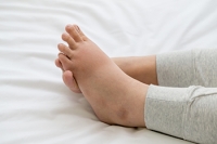 Causes of Swollen Ankles and Feet