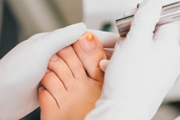 The Pros of Laser Treatment for Toenail Fungus